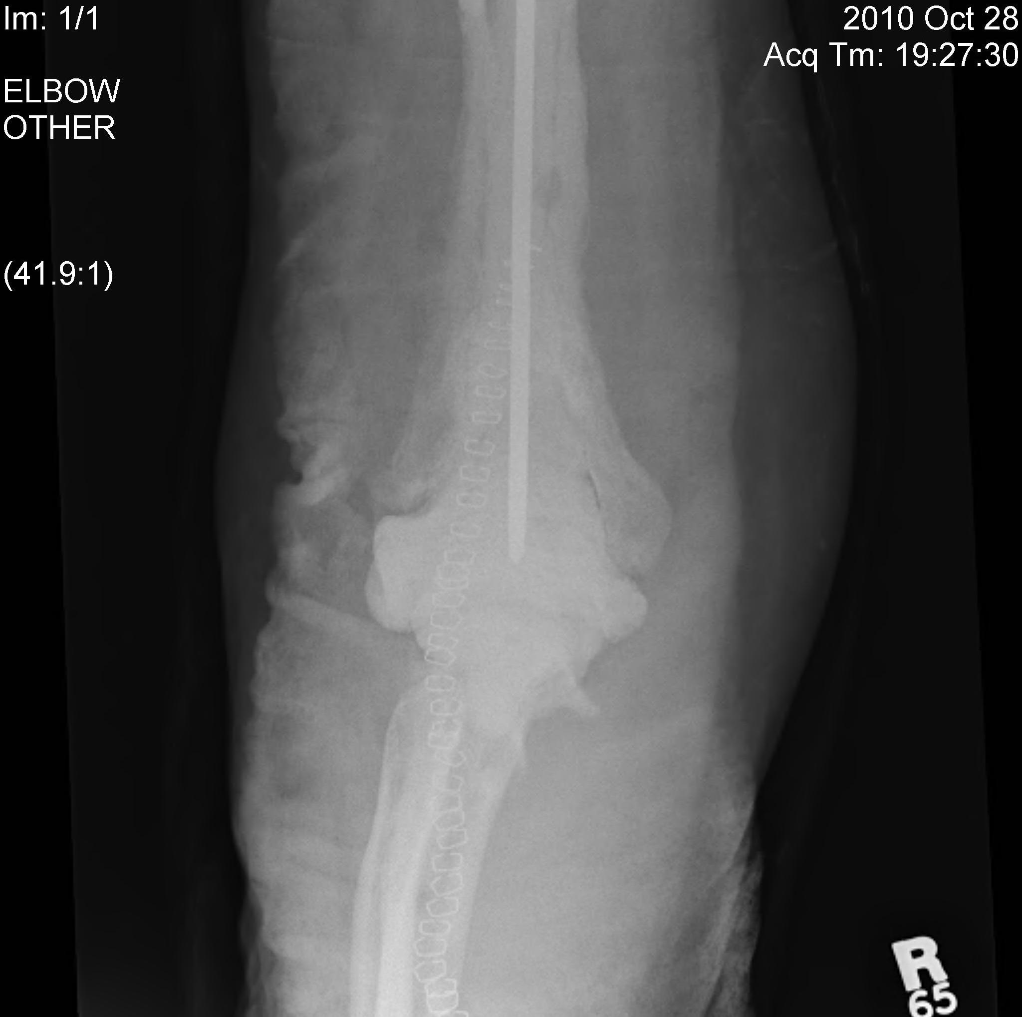 1. stádiumú brachialis artrosis térdízület kezelése caripazimmal